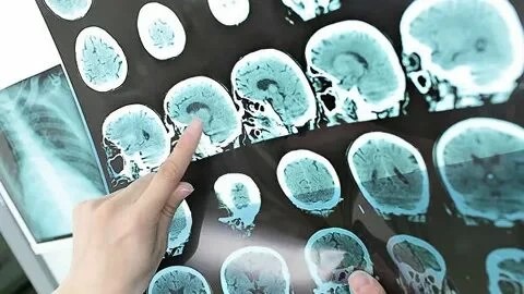 В Московской области заработали 2 новых центра рассеянного склероза и нейроиммунологических заболеваний