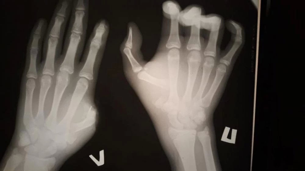 Хирурги РБ пришли оторванный палец маленькому спортсмену